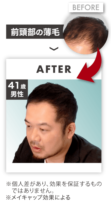 前頭部の薄毛