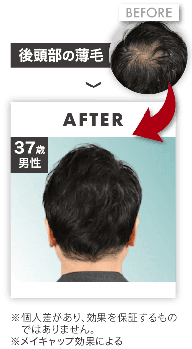 後頭部の薄毛